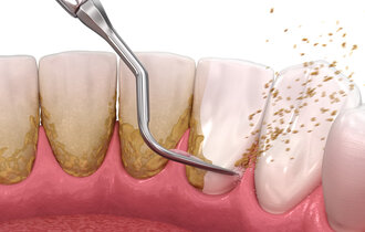 Oral,Hygiene:,Scaling,And,Root,Planing,(conventional,Periodontal,Therapy).,Medically