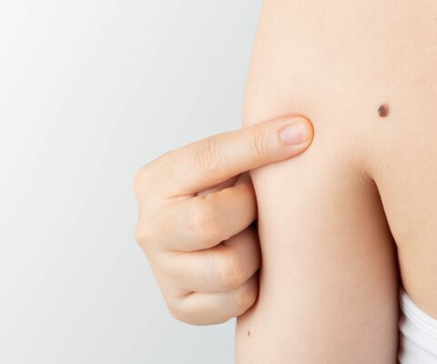 Young,Woman,Pointing,At,Dark,Brown,Moles,On,Her,Back