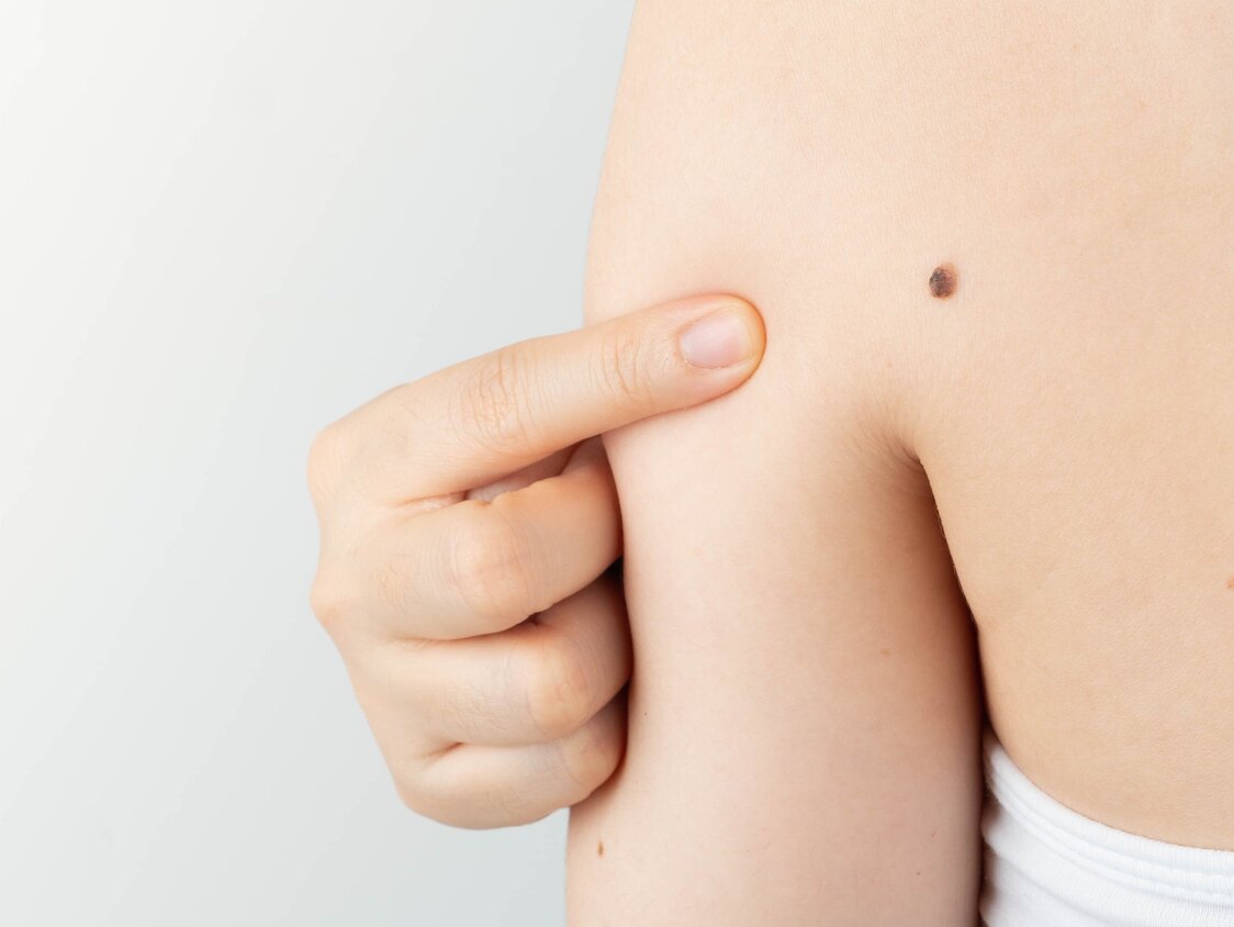 Young,Woman,Pointing,At,Dark,Brown,Moles,On,Her,Back