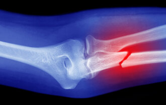 Ein Röntgenbild einen gebrochenen Arms
