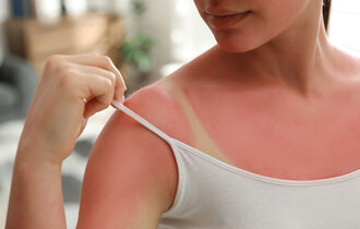 Eine Frau mit Sonnenbrand am Oberkörper. Sie zieht den Träger ihres Tops zur Seite, darunter ist ein weißer Abdruck.